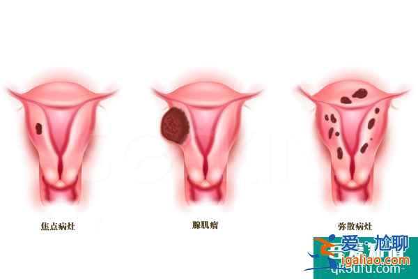 子宫腺肌症，去泰国做试管婴儿成功率有多少？？