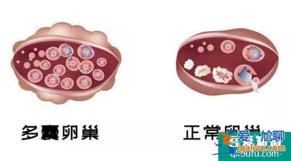 多囊卵巢综合症赴美做试管婴儿，能成功吗？？