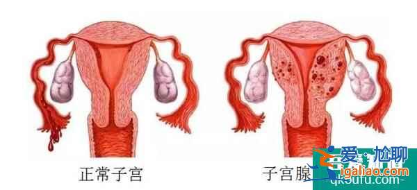 试管婴儿为子宫腺肌症患者保孕护航？