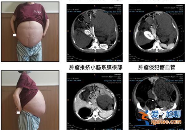 女子回国求医医生历经5小时切除其腹腔重达25公斤肿瘤[医生]？